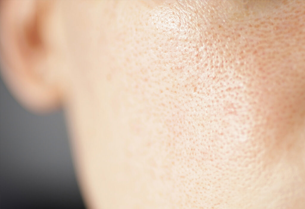 Tratamento para Poros Abertos